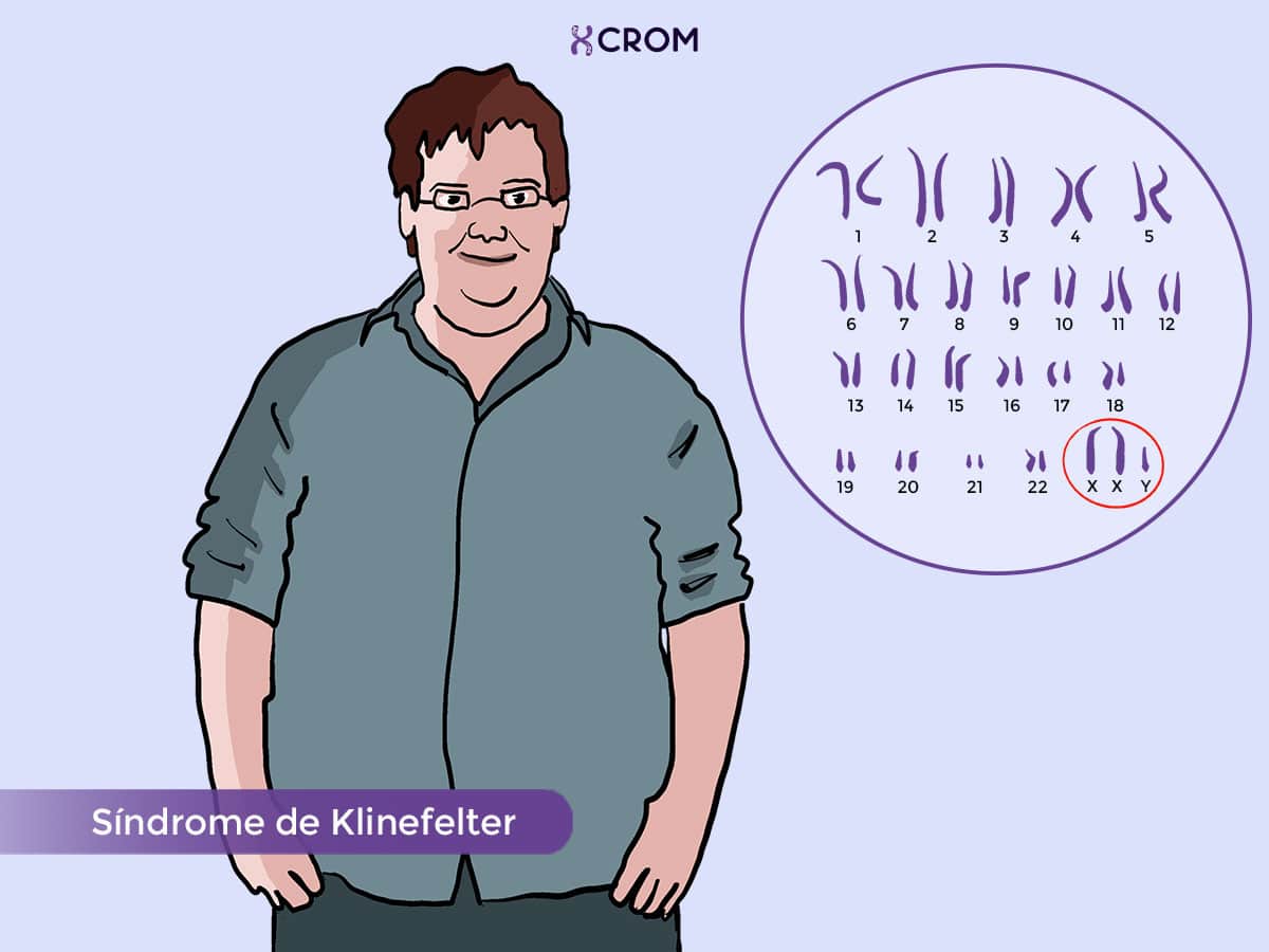 Ficha técnica Síndrome de Klinefelter CROM Instituto de Citogenética Humana Ficha técnica Síndrome de Klinefelter CROM Instituto de Citogenética Humana
